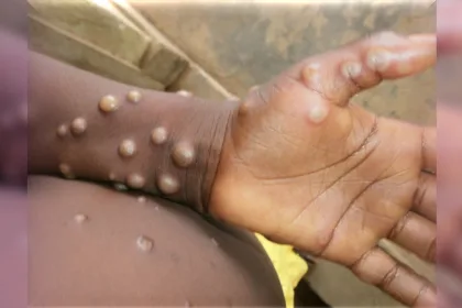 WHO declares Global Emergency over mpox outbreak. Here’s all you need to know.