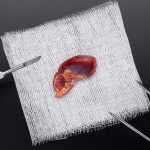 Liver Transplantation Enters the Era of Precision Diagnostics