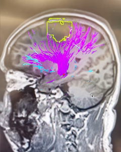 The scan shows the green tumor area. Portions entangled with vital nerves were left untouched during surgery to preserve movement. These areas are now targeted by chemotherapy.