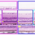 Eye Disease