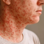 Measles outbreak