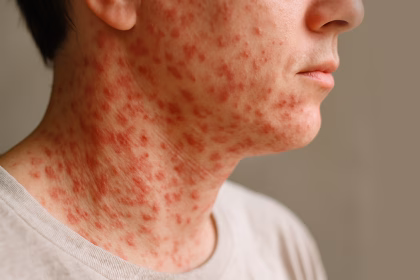 Measles outbreak