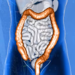 Inflammatory Bowel Disease