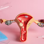 Female Genital Mutilation