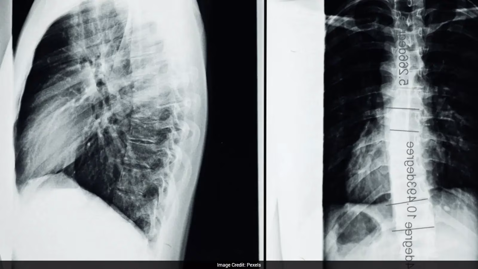 World’s First Spinal Cord Transplant Reported in Russia for Paralysed Patient